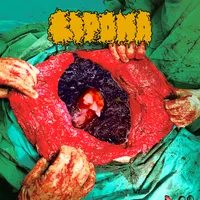 Lipoma